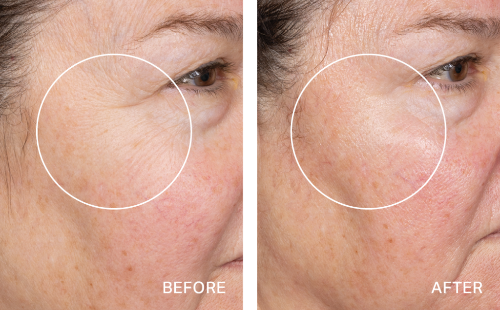 Non Member- Deluxe HA Hydralock HydraFacial® – Package of 3