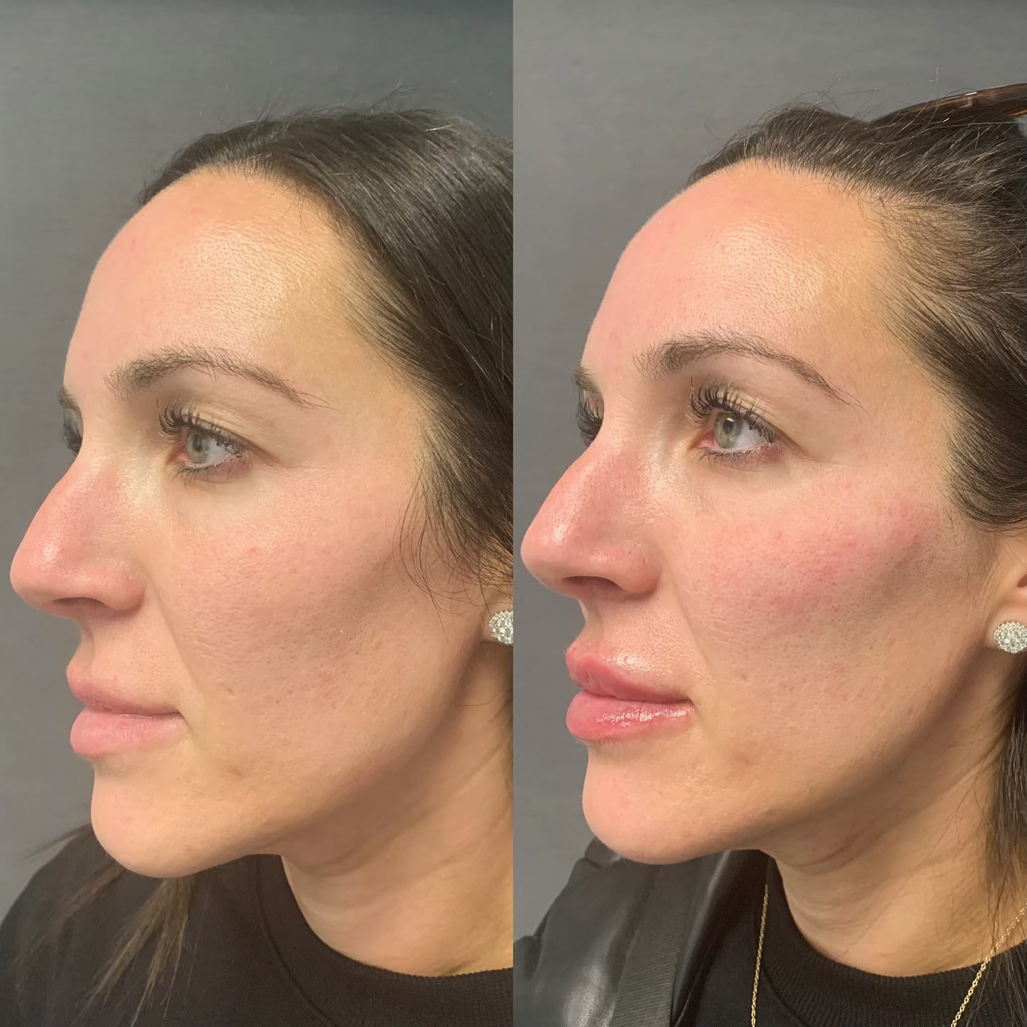 Member- July Special: JUVÉDERM VOLUMA XC Buy One, Get One 50% Off