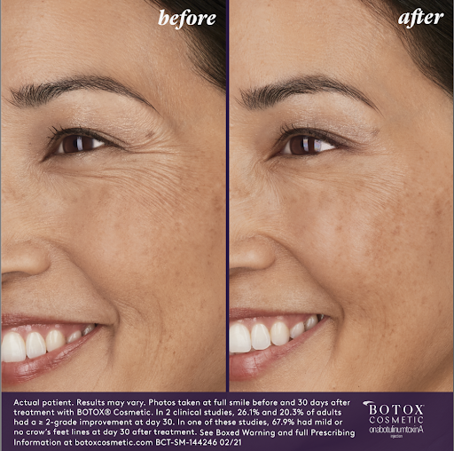 Member - 30 Units of Botox $279