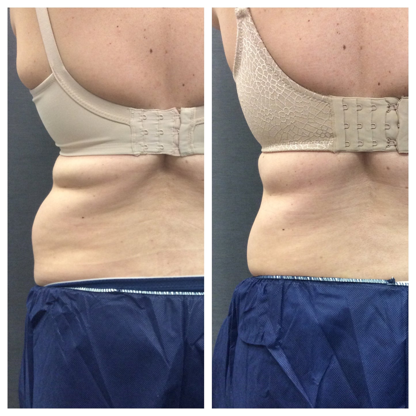 CoolSculpting – Flanks (Love Handles)