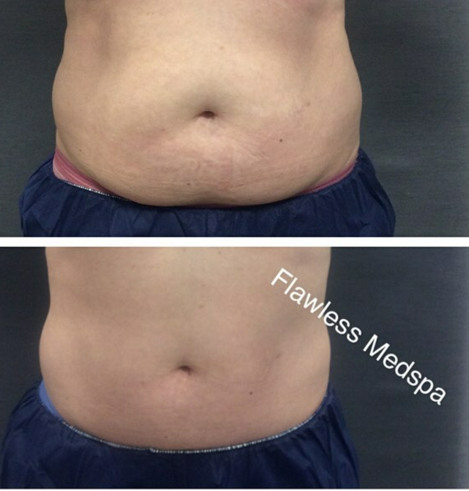 CoolSculpting Treat-to-Complete: Save $600 Upper or Lower Abdomen
