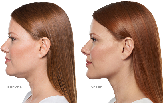 Buy 2 Kybella Vials, Get 2 FREE