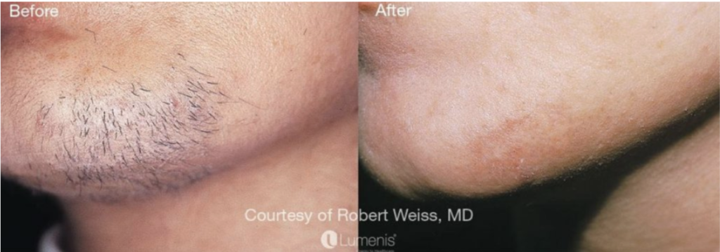 Upper Lip & Chin Laser Hair Removal – 6 Sessions (Norwell)