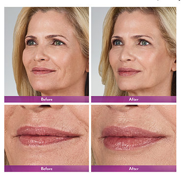 Volbella 1.0ml + 15 Units of Botox FREE- Member