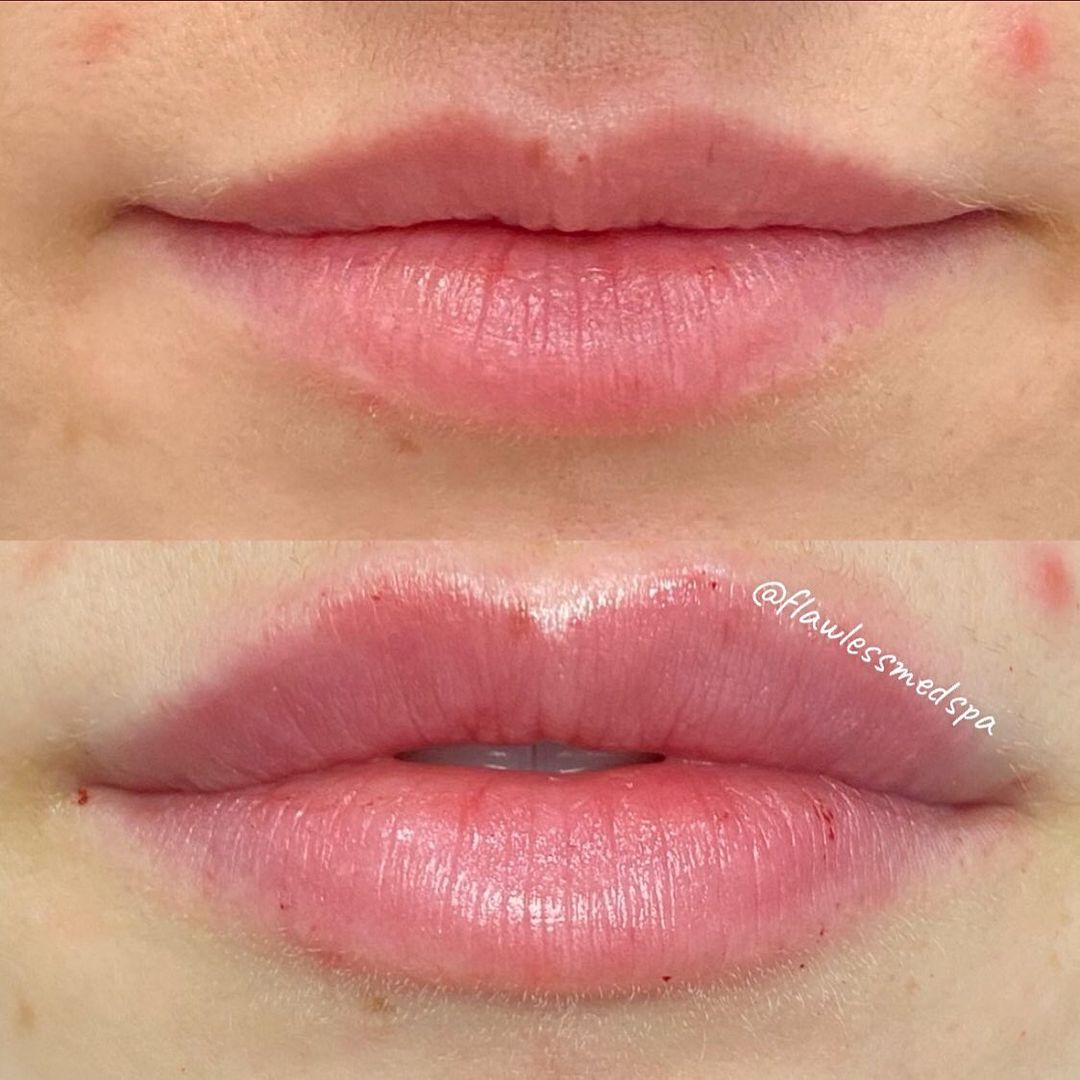 Mini Lip Filler – $300 (½ syringe Juvederm Ultra XC or Volbella)