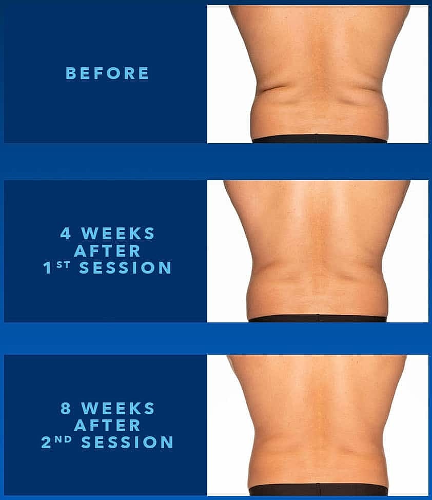 CoolSculpting Elite Treat-to-Complete Flanks — Norwell