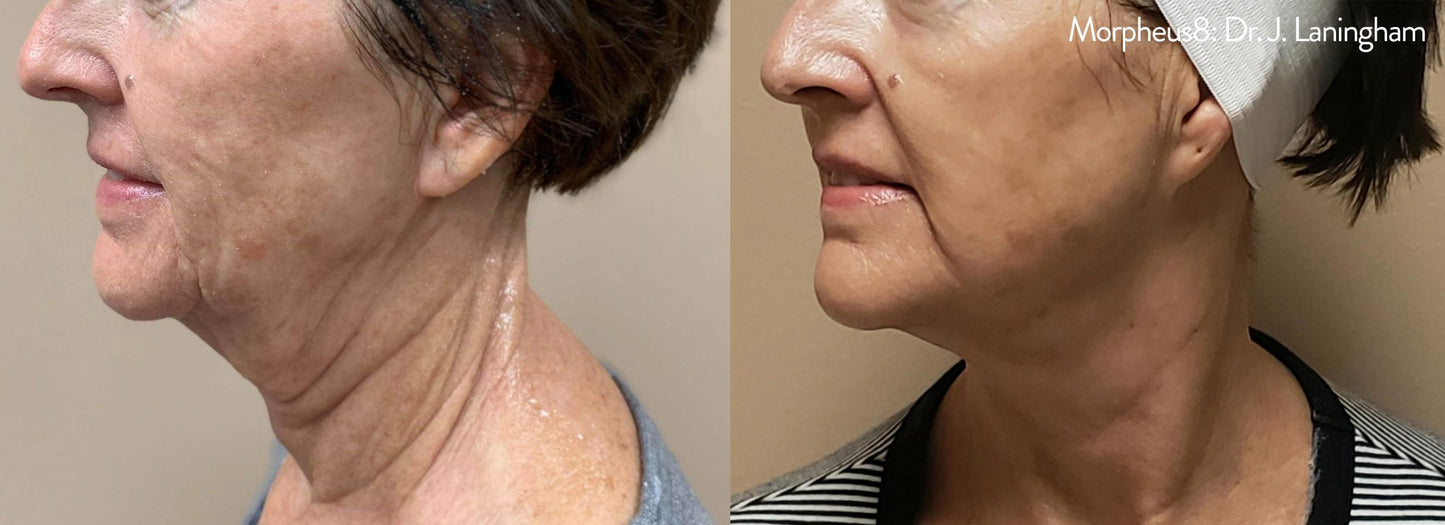 Morpheus8 (Face + Neck)