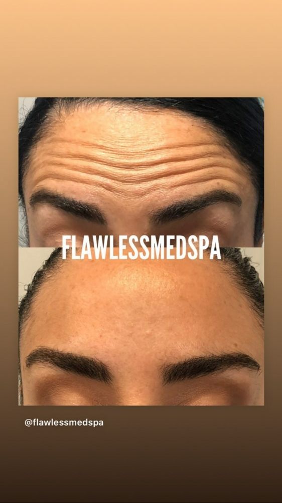 Member- 24-Hour Botox FLASH SALE!