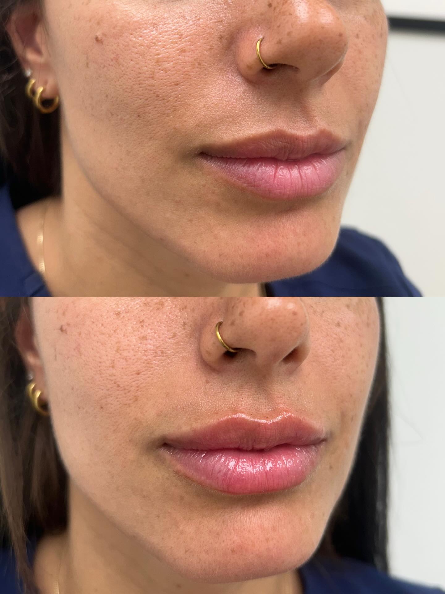 Lip Filler Special – $75 Off Member Juvederm Ultra XC