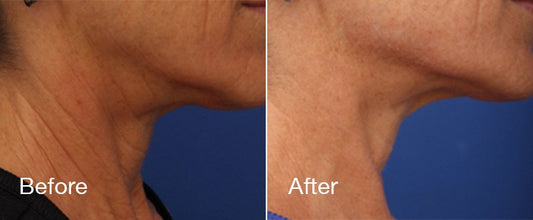 RF Skin Tightening Neck Package (Lumenis Legend Pro) + FREE 25 Units of Botox®