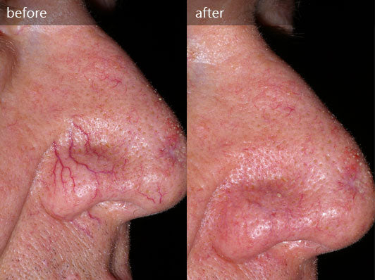 1 Treatment- October Special 🕷: Say Goodbye to Unsightly Veins with Laser Spider Vein Removal-