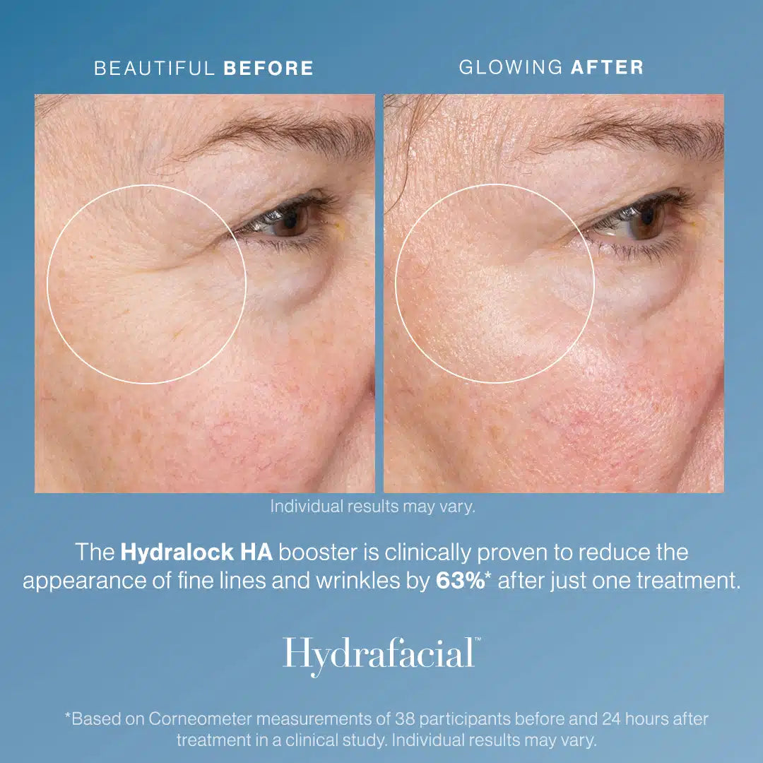 Member - Deluxe HA Hydralock HydraFacial® – Package of 3