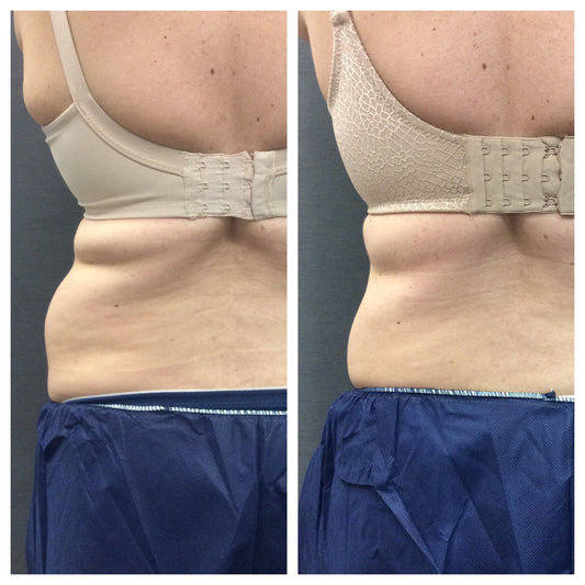 CoolSculpting – Flanks (Love Handles)
