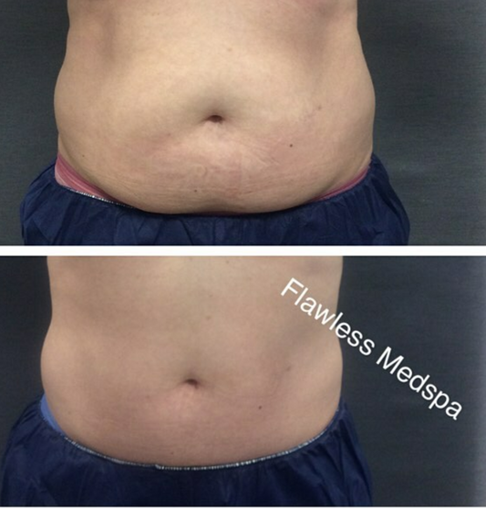 CoolSculpting Treat-to-Complete: Save $600 Upper or Lower Abdomen