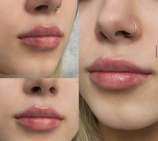 JUVÉDERM Ultra Lip Special: $500