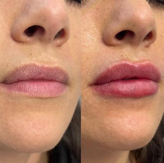 Member Exclusive: JUVÉDERM Ultra Lips for $450