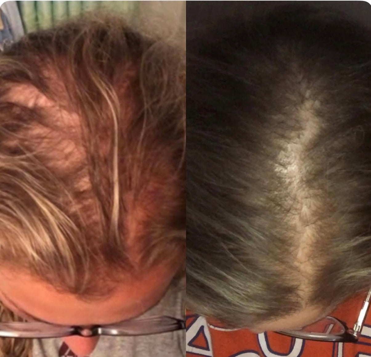 PRP Hair Restoration: 3 Treatments for $1,350