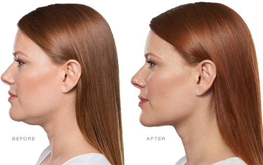 Buy 2 Kybella Vials, Get 2 FREE