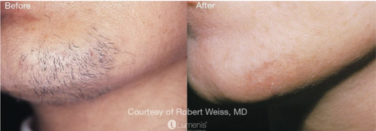 Upper Lip & Chin Laser Hair Removal – 6 Sessions (Norwell)