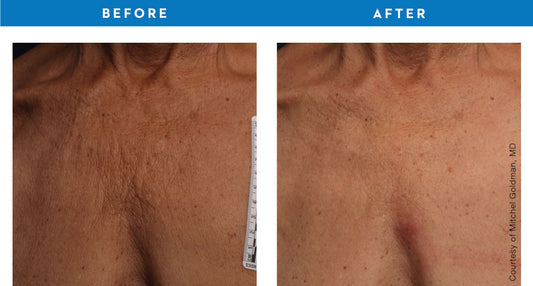 Ultherapy Décolletage Treatment – July Special