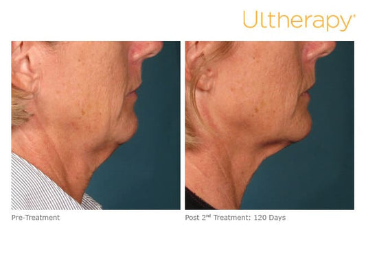 December Special: Ultherapy Full Neck – 50% Off (Now $1,250)