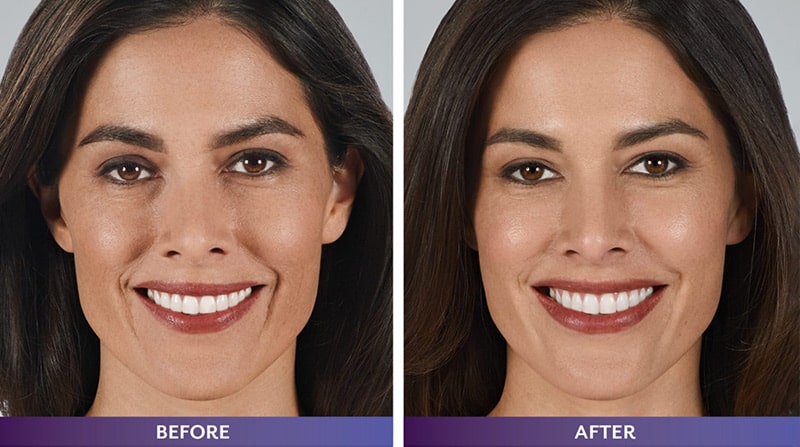 Juvéderm Vollure Filler Specials (Non Member 2 Syringes)