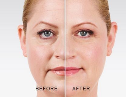 Facial Balancing Special: Cheeks + Jawline