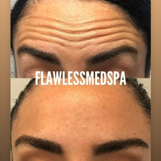 Botox – 30 Units (Norwell)