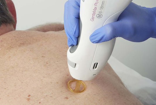 Member Laser Hair Removal – Brazilian + Underarms Package (6 Sessions)