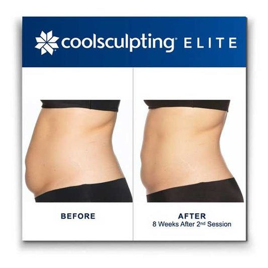 CoolMonth is Here! Coolsculpting Buy 4 Cycles get 4 Free
